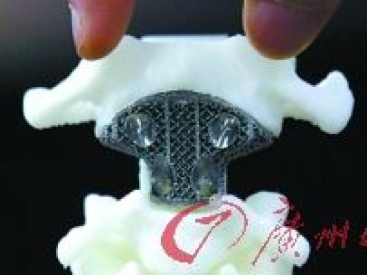 3D打印脊椎植入人体