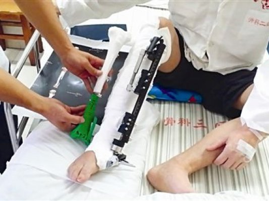 眼下最热门的3D打印技术在广西的医院里派上用场