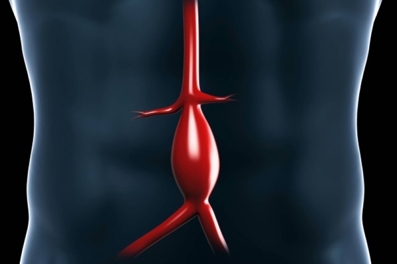 用3D打印治疗动脉瘤技术获700万美元风投