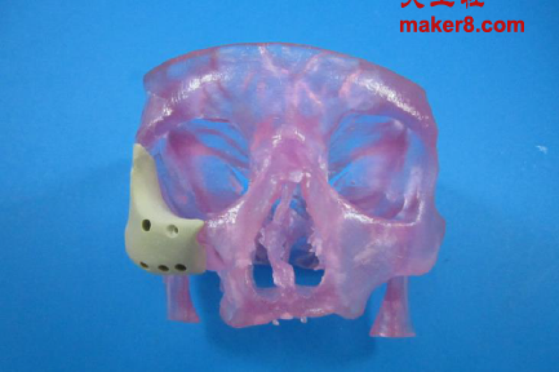 FDA首次批准3D打印面部植入物进入市场