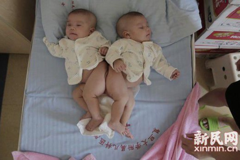 上海首次使用3D打印技术辅助分离联体婴儿