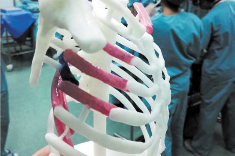 25岁小伙断7根肋骨 3D打印助顺利手术修复