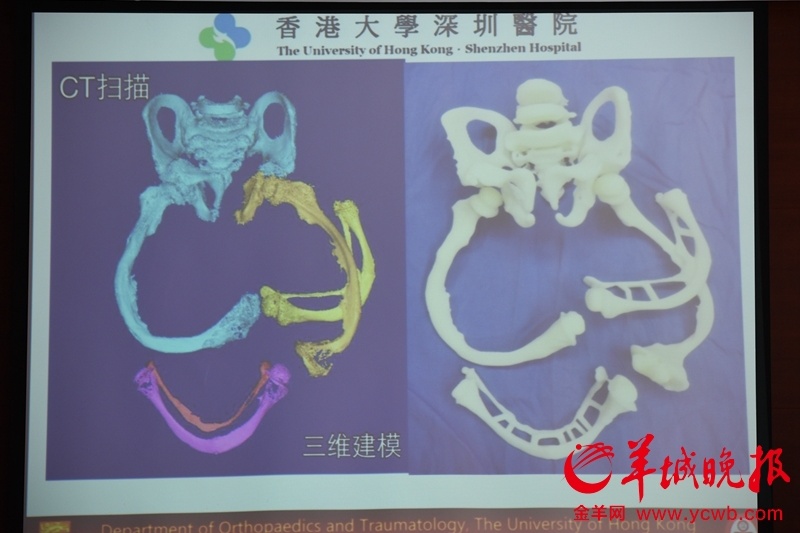 3D打印帮助6岁“玻璃骨”男孩重新站立