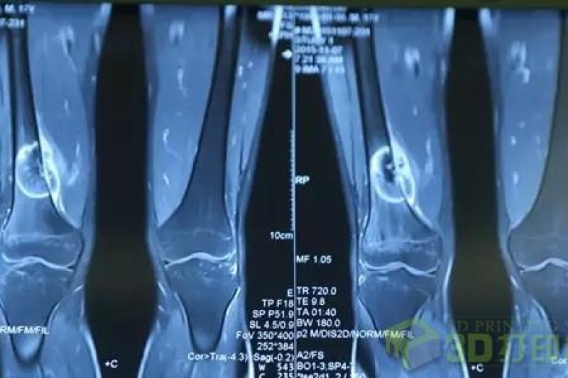 湘雅医院采用3D打印技术 为患者保住关节功能