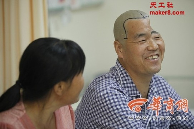 陕西男子半头缺失3D打印钛网修复脑盖