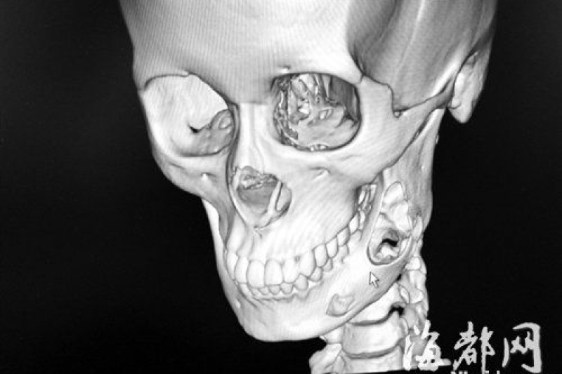 17岁少女下巴受肿瘤吞噬 3D打印帮大忙