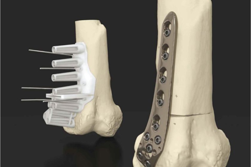 3D打印等7类医疗器械将获国家重点扶持