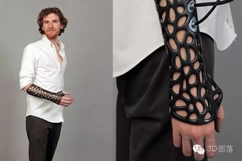 3D打印在义肢行业和康复辅具的新思路