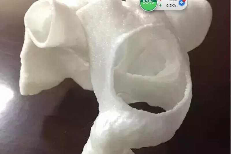 3D打印技术助力打破手术禁区——交大一附院完成巨大双孔下腔型房间隔缺损封堵手术