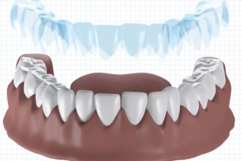 【案例】3D打印定制隐形牙箍，法国Dentosmile怎么做？
