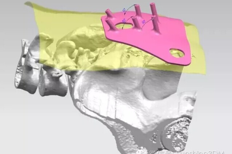 光韵达助力全球首例成功应用3D打印技术治疗功能泌尿疾病手术
