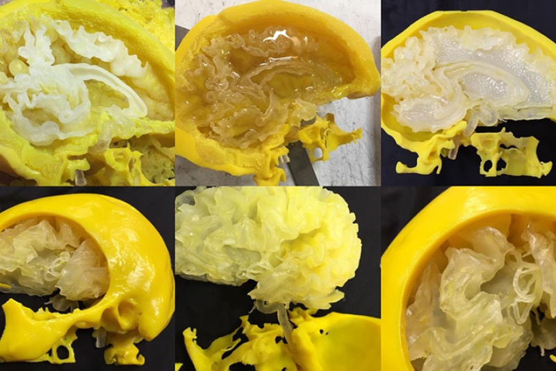 携手Stratasys 圣路易斯3D打印精准脑瘤模型用于手术辅助