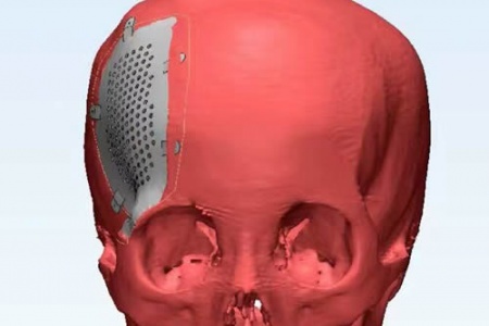 重庆完成罕见颅面部畸形3D打印假体置换手术