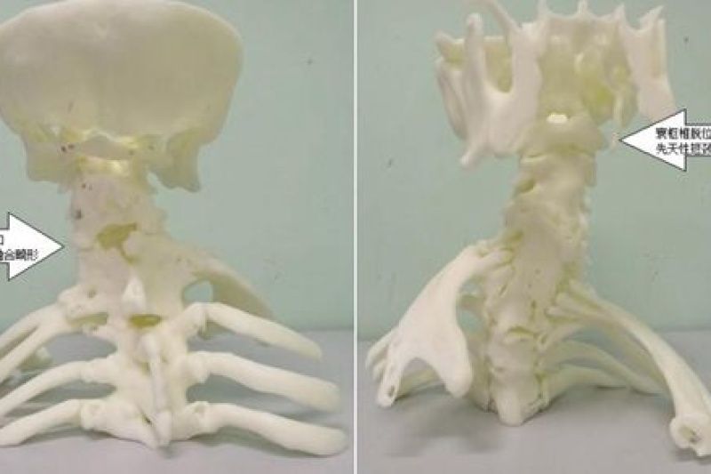 50年的超复杂短颈畸形将致其瘫痪，仁济医院用3D打印救他一命