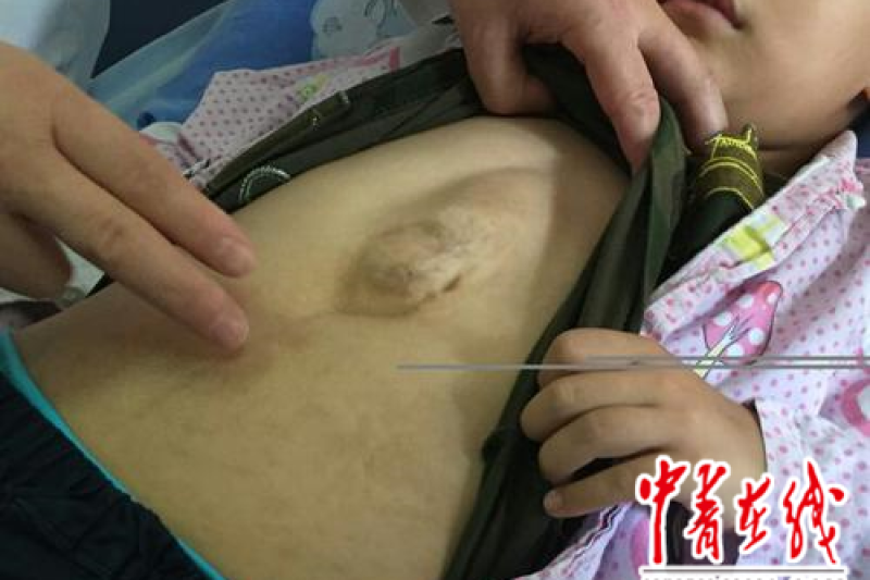 非常罕见疾病！上海医院3D打印PEEK胸骨“外壳”拯救心脏外突小患者