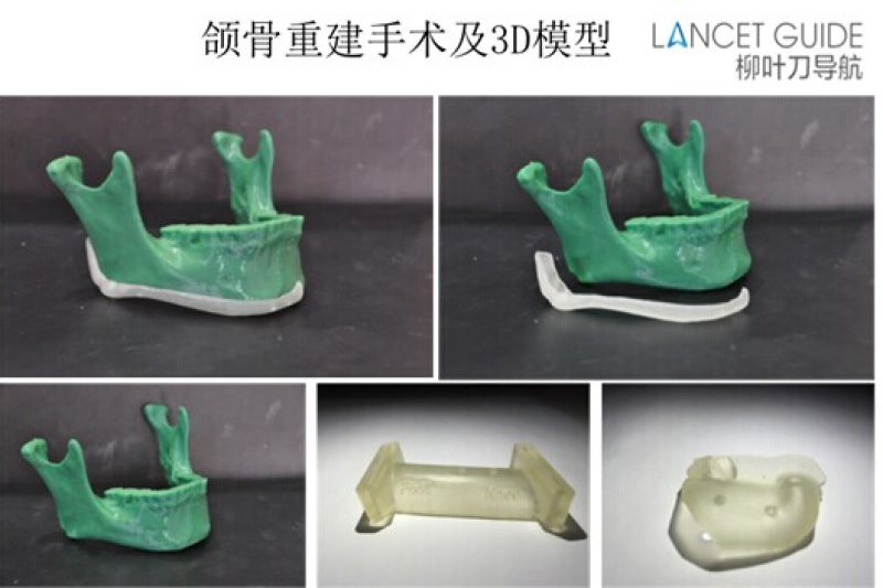 3D打印在颌面外科中的应用