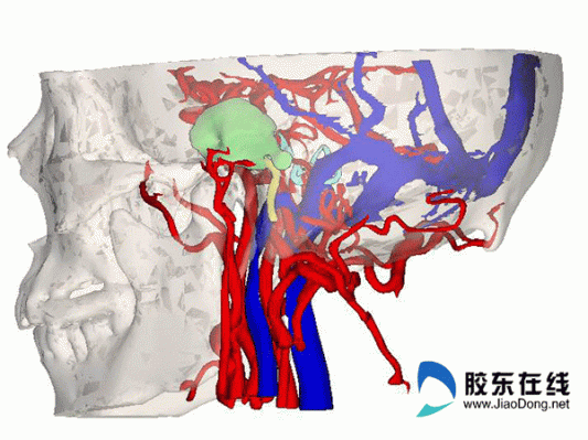 虚拟现实+混合现实+3D打印，山东医生戴上MR眼镜成功完成侧颅底肿瘤切除手术