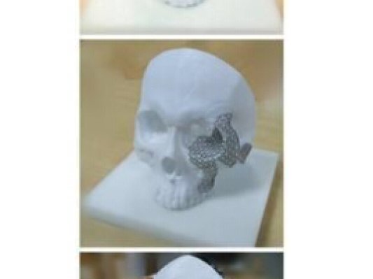 90后云南小伙面部意外粉碎性骨折  3D打印技术“再造”新脸