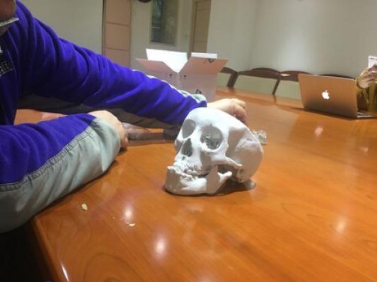 8岁小孩摔一跤颅底穿洞，广州医生用3D打印 PEEK“小塞”修补
