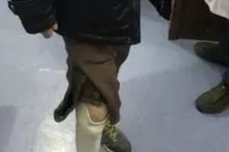 鞍钢退休工人戴上辽宁第一个3D打印义肢，两个字：舒适