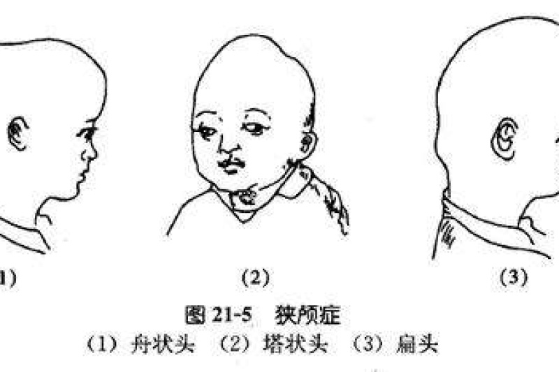 10月大婴儿酷似外星人，3D打印帮助重拼颅骨