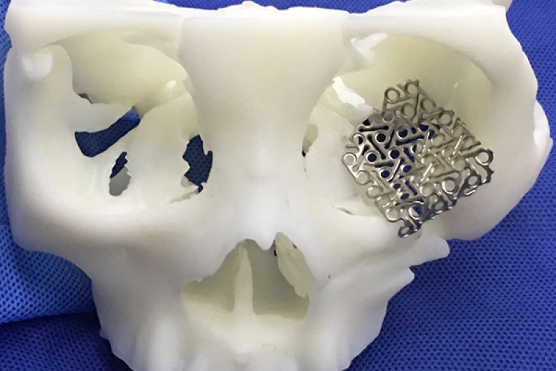 眼眶严重骨折，郴州医院成功进行3D打印钛网修复术