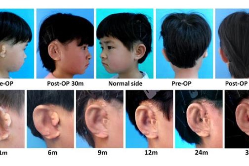 中国科学家利用3D打印技术为小耳症儿童培育新耳朵