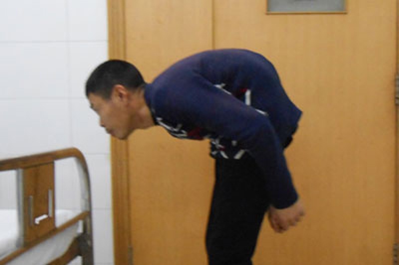 3D打印技术让驼背患者“直立行走”