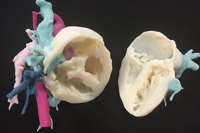3D打印一改先天性心脏病的治疗方式