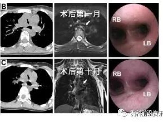 唐都医院4D打印气管外支架成功救治气管软化症患儿