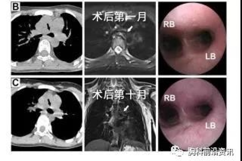 唐都医院4D打印气管外支架成功救治气管软化症患儿