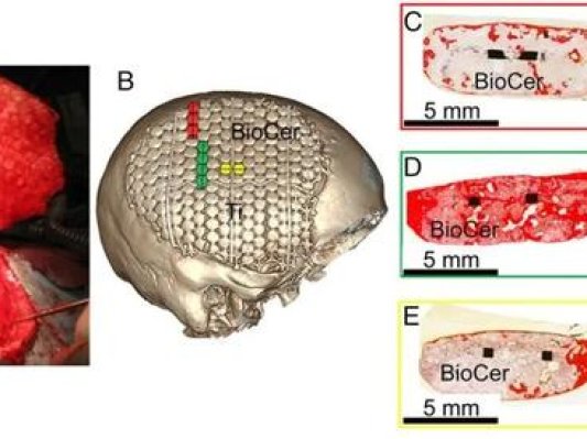 瑞典科学家研发3D打印生物陶瓷植入物可诱导颅骨再生