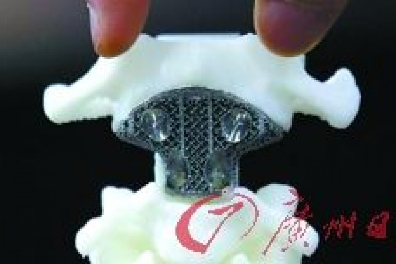 3D打印脊椎植入人体