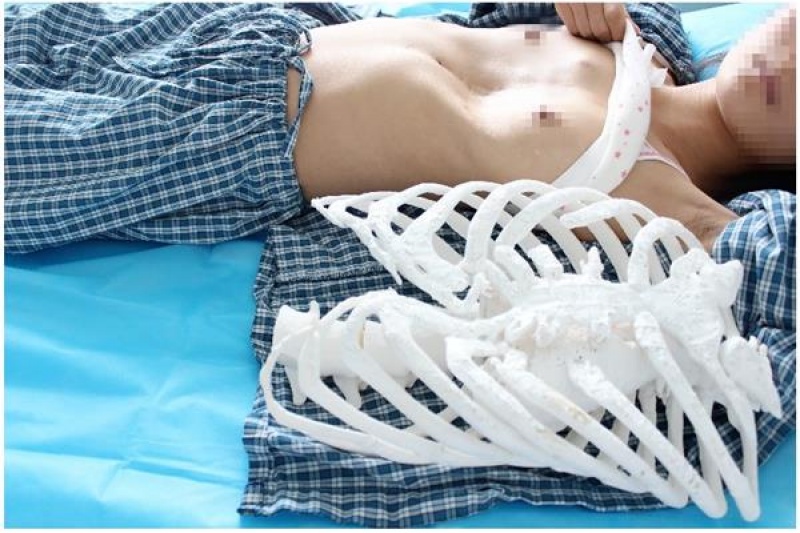 中国完成世界首例3D打印漏斗胸矫形手术