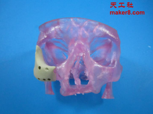 FDA首次批准3D打印面部植入物进入市场