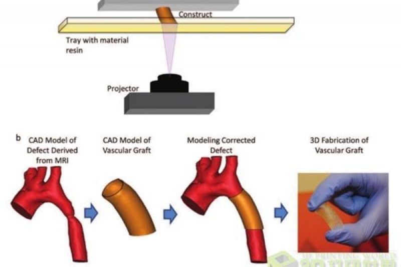 先天性心脏病“克星” 美国研究团队开发3D打印血管植入物