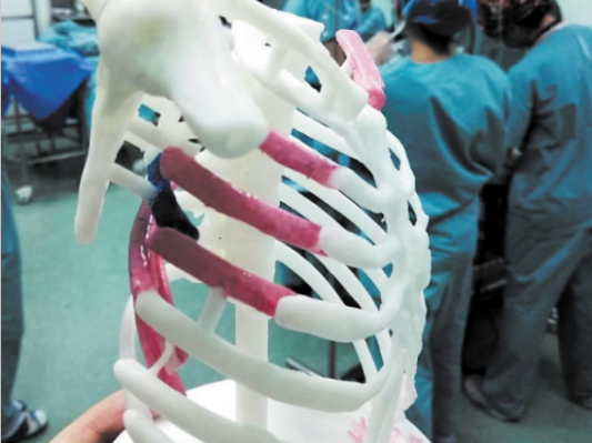 25岁小伙断7根肋骨 3D打印助顺利手术修复