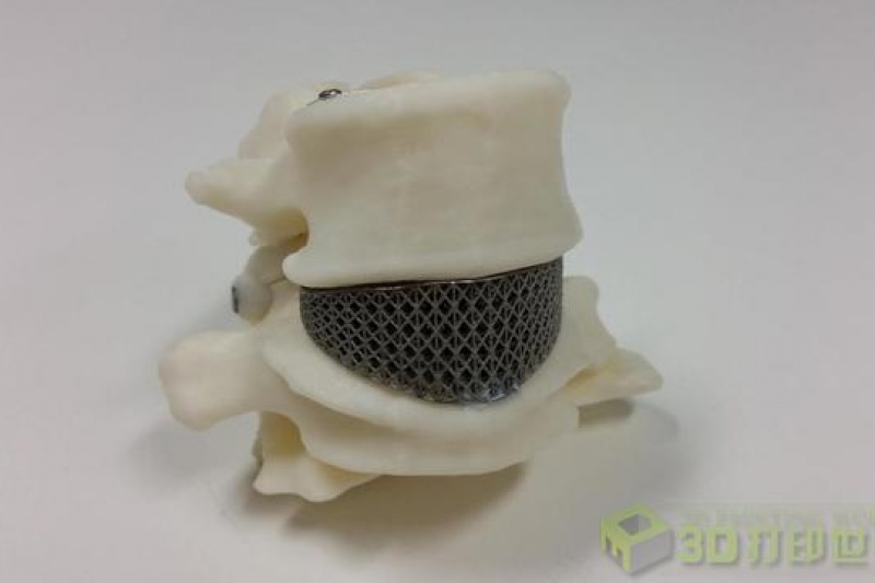 澳大利亚完成首例3D打印钛金属脊柱植入手术