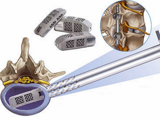德国公司3D打印椎间植入物获FDA销售许可