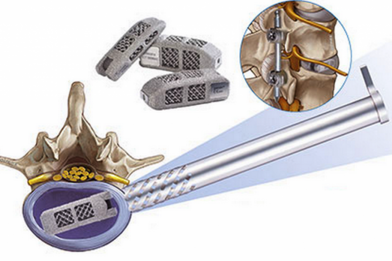 德国公司3D打印椎间植入物获FDA销售许可