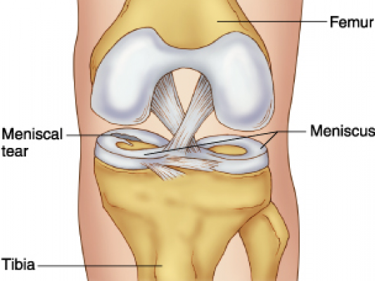 3D打印植入物促进膝关节半月板再生研究获成功