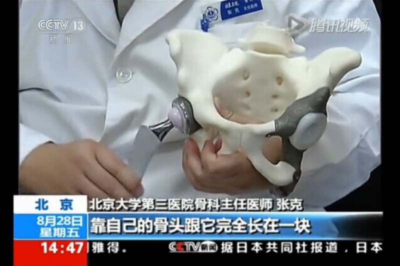 政策终“松绑” 中国首个3D打印人体植入物获批