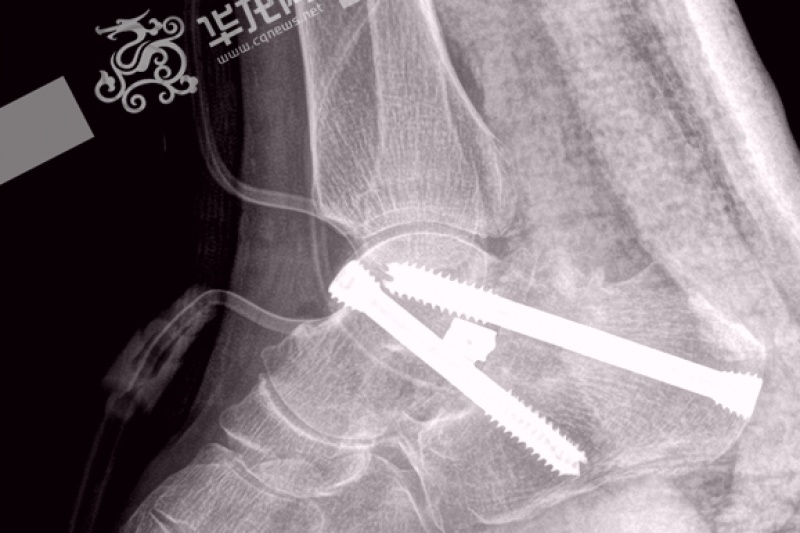 重庆完成两例3D打印治疗足踝关节畸形手术 或在骨关节手术领域推广
