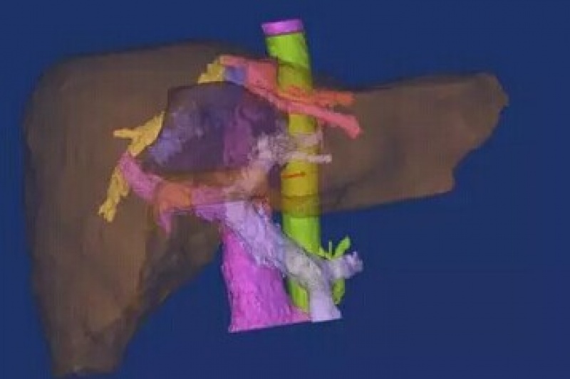 湖南省肿瘤医院：3D模拟重建技术绘制手术“禁区”地图