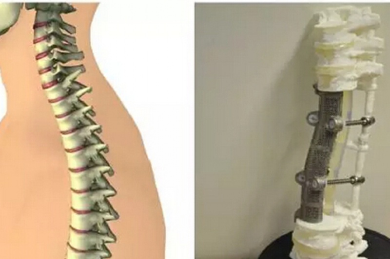 为中国医生点赞！全球首次19厘米长3D打印脊椎植入手术成功