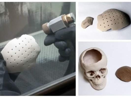 俄国研发可吸收3D打印植入物  促进颅骨快速恢复生长