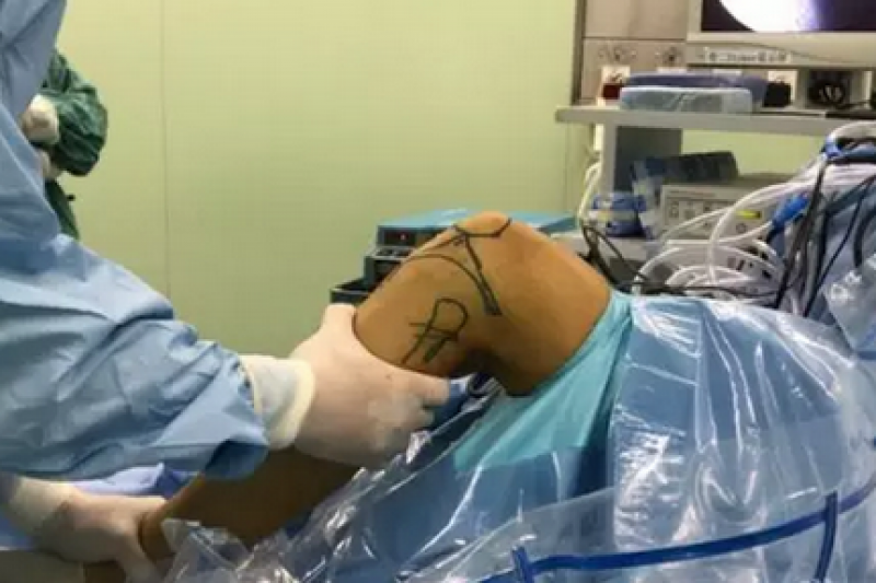 多图详解：广西医药借3D打印进行前交叉韧带返修手术