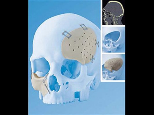 强生强势引进TRS的3D打印骨骼技术
