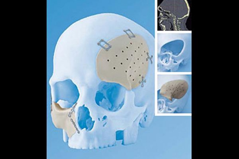 强生强势引进TRS的3D打印骨骼技术