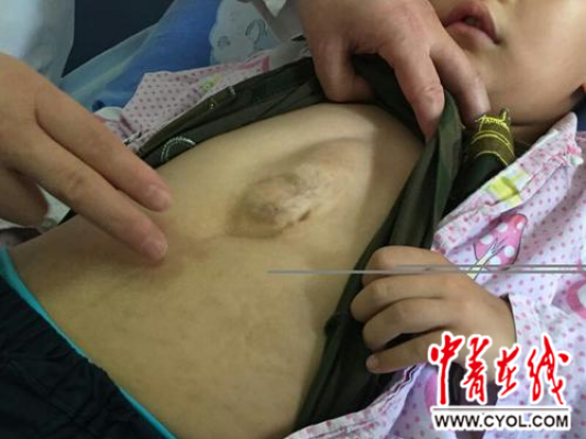 非常罕见疾病！上海医院3D打印PEEK胸骨“外壳”拯救心脏外突小患者